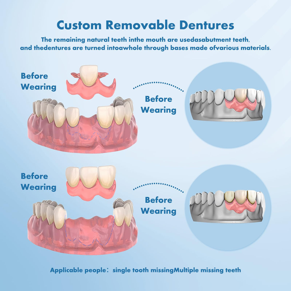 Custom Removable Dentures Set (1 Tooth) C944860